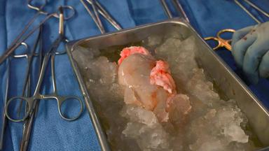 Xenotransplantation einer Schweineniere