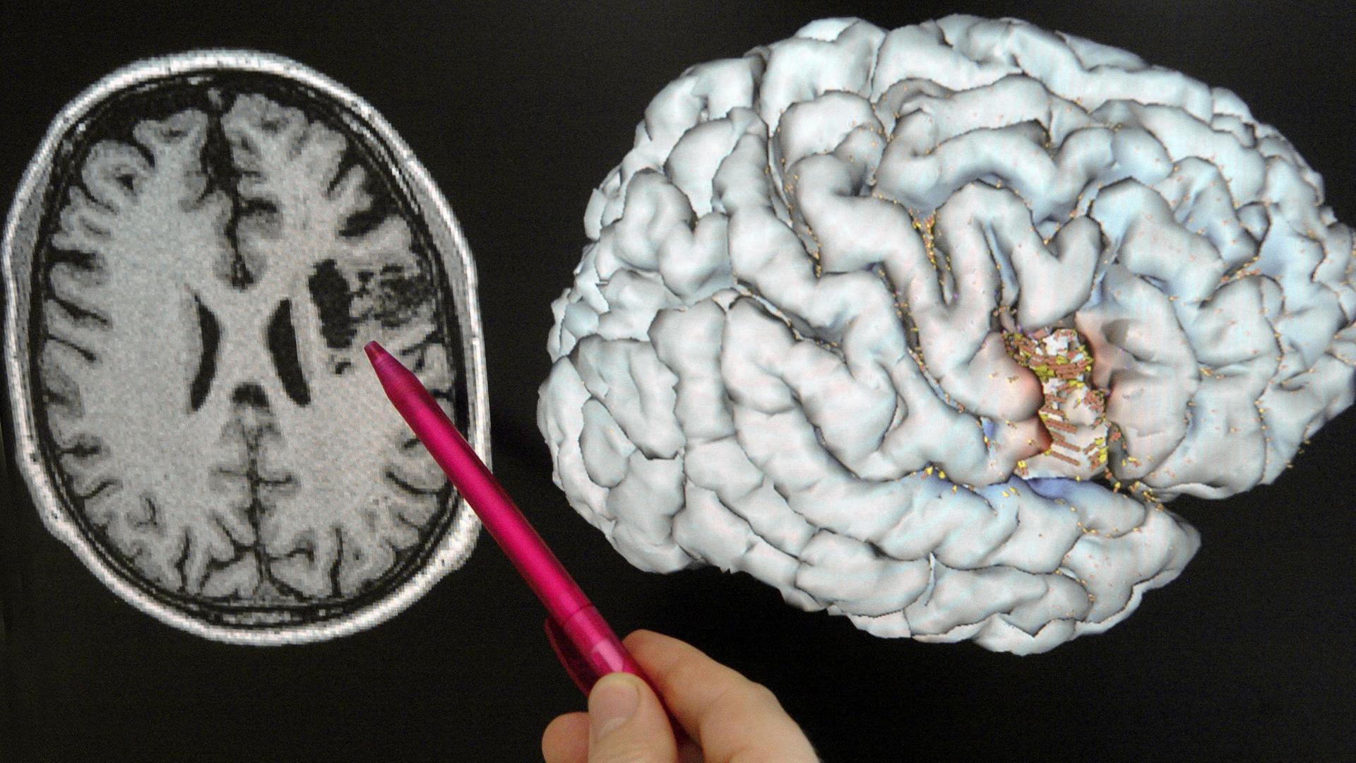 Hirnforschung: Hoffnung auf Heilung - Hirntumor-Netzwerk erklärt Rückkehr von Krebs