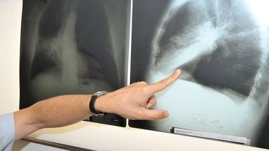 Radon verursacht tausende Lungenkrebsfälle pro Jahr. Besonders im Winter sammelt es sich in Kellern und Erdgeschossen. (Bild: Rontgenaufnahme einer Lunge)