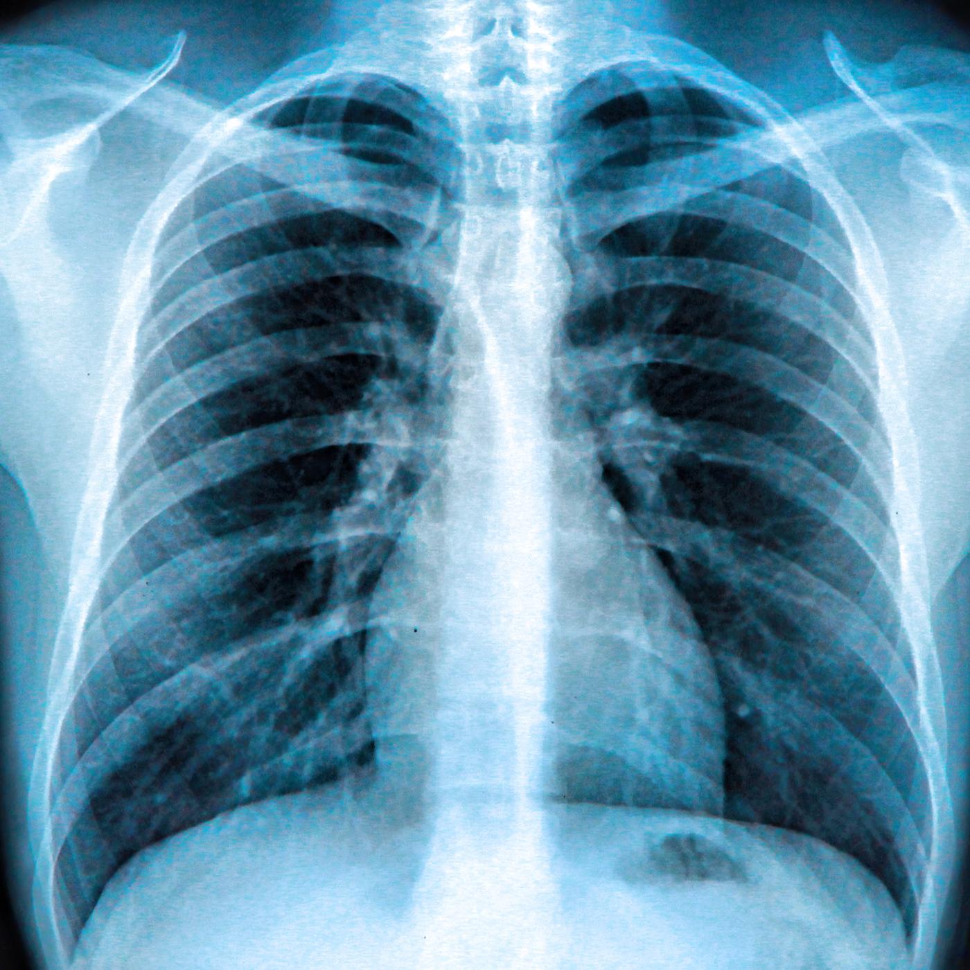 Röntgenaufnahme eines Brustkorbs