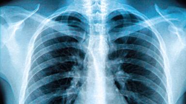 Röntgenaufnahme eines Brustkorbs