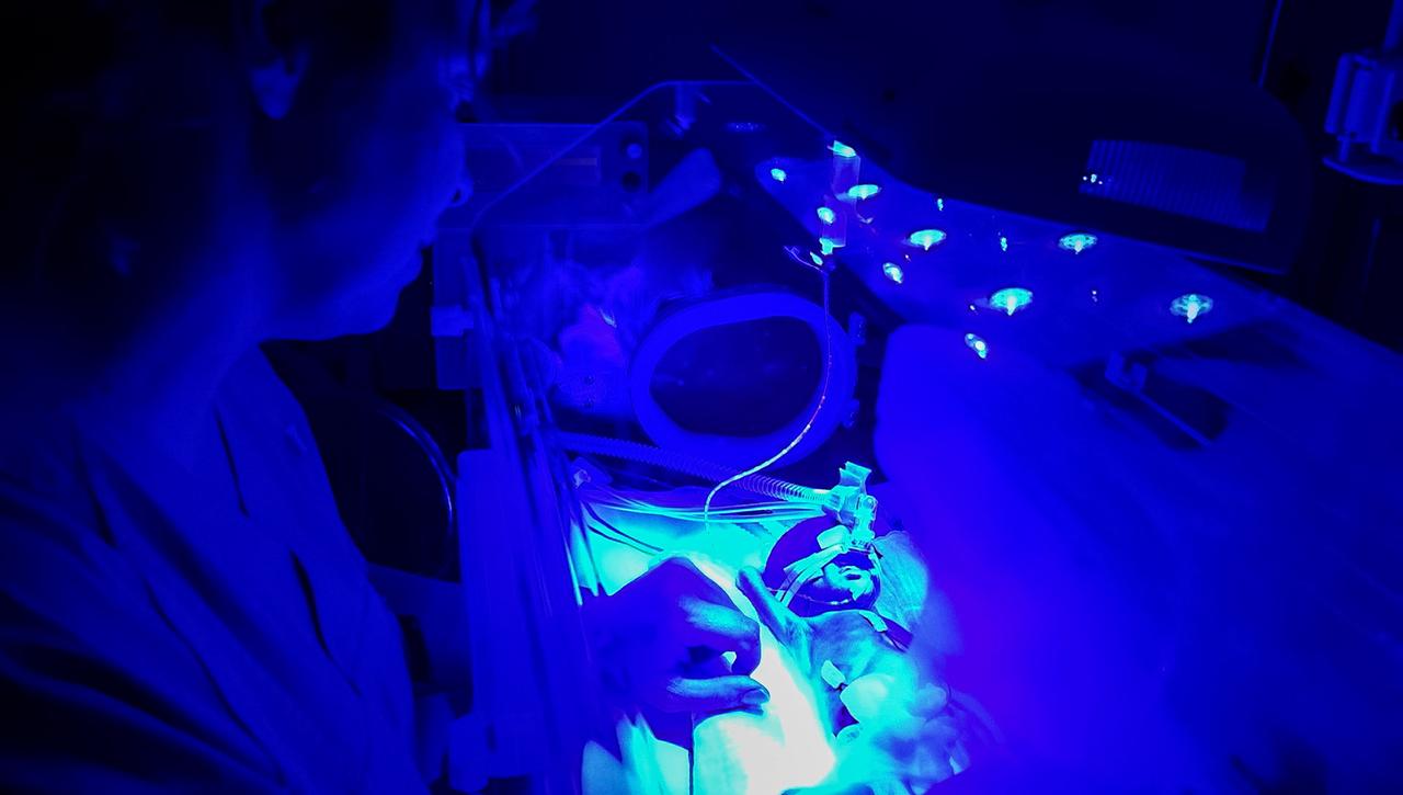 Frühgeborenes im Inkubator wird mit blauem Licht der Fototherapie behandelt und gleichzeitig von einer Krankenschwester per Magensonde mit Muttermilch ernährt.
