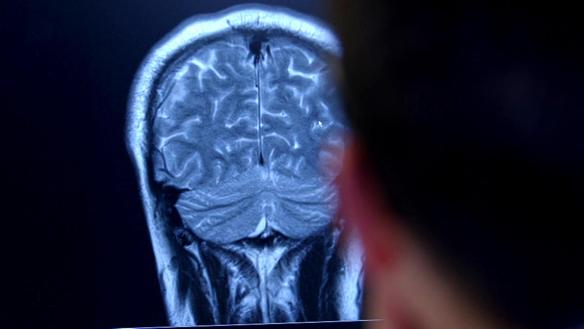 Ein Arzt blickt auf die Aufnahme eines Gehirnscans.