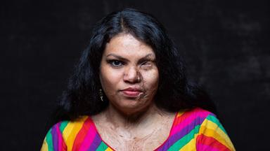 Das Bild zeigt eine Frau mit langen, lockigen, schwarzen Haaren, die an einer dunklen Wand posiert. Sie trägt ein farbenfrohes Oberteil mit breiten, horizontalen Streifen in verschiedenen Farben, darunter Rot, Gelb, Grün und Lila. Die Frau hat eine markante Miene und einen intensiven Blick. Ihr Gesicht weist sichtbare Narben auf, insbesondere auf der linken Seite, wo auch ein Auge teilweise verdeckt ist. Ihre Haut hat eine unterschiedliche Textur und Farbe, was auf eine Verletzung oder eine medizinische Bedingung hinweisen könnte. Der Hintergrund ist neutral und trägt zur Fokussierung auf die Frau bei.